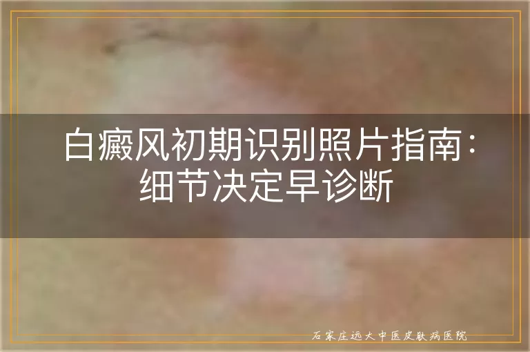 白癜风初期识别照片指南：细节决定早诊断