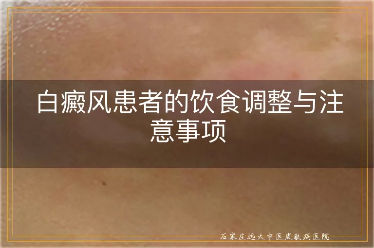 白癜风患者的饮食调整与注意事项