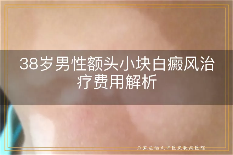 38岁男性额头小块白癜风治疗费用解析