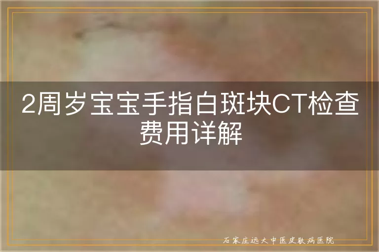 2周岁宝宝手指白斑块CT检查费用详解