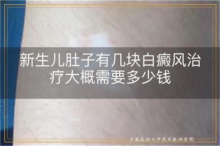新生儿肚子有几块白癜风治疗大概需要多少钱
