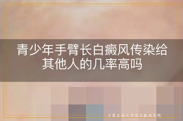 青少年手臂长白癜风传染给其他人的几率高吗