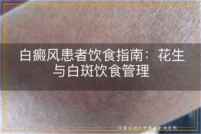 白癜风患者饮食指南：花生与白斑饮食管理