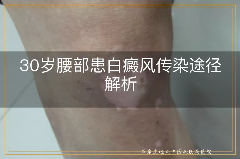 30岁腰部患白癜风传染途径解析