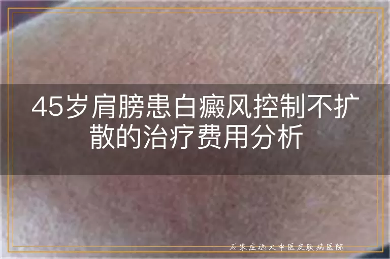 45岁肩膀患白癜风控制不扩散的治疗费用分析