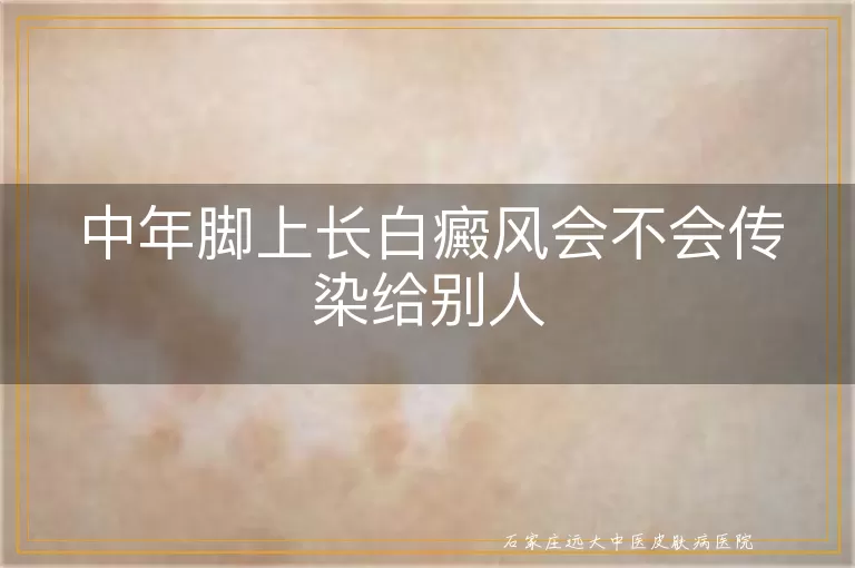 中年脚上长白癜风会不会传染给别人