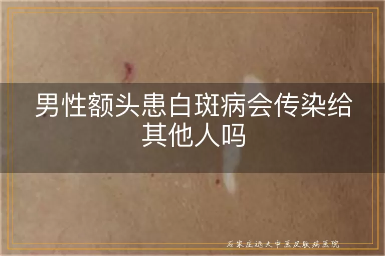 男性额头患白斑病会传染给其他人吗
