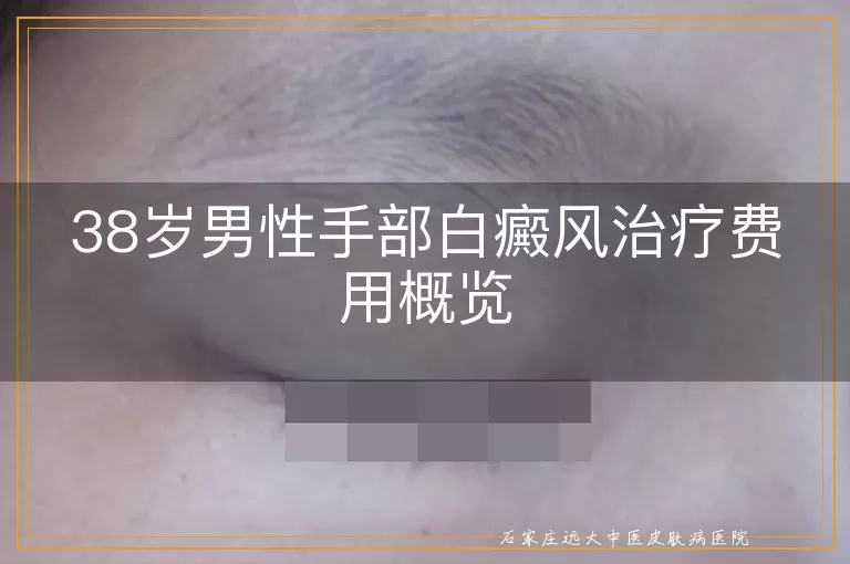 38岁男性手部白癜风治疗费用概览