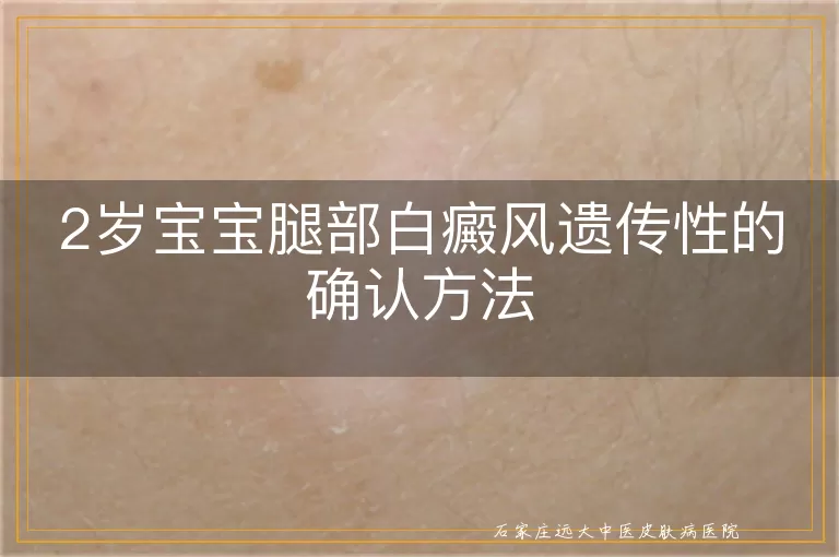 2岁宝宝腿部白癜风遗传性的确认方法