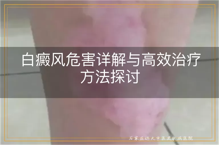 白癜风危害详解与高效治疗方法探讨