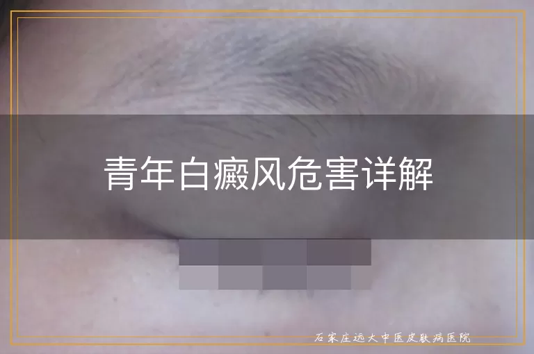 青年白癜风危害详解