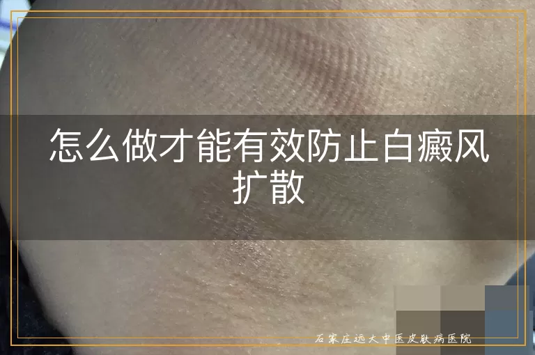 怎么做才能有效防止白癜风扩散