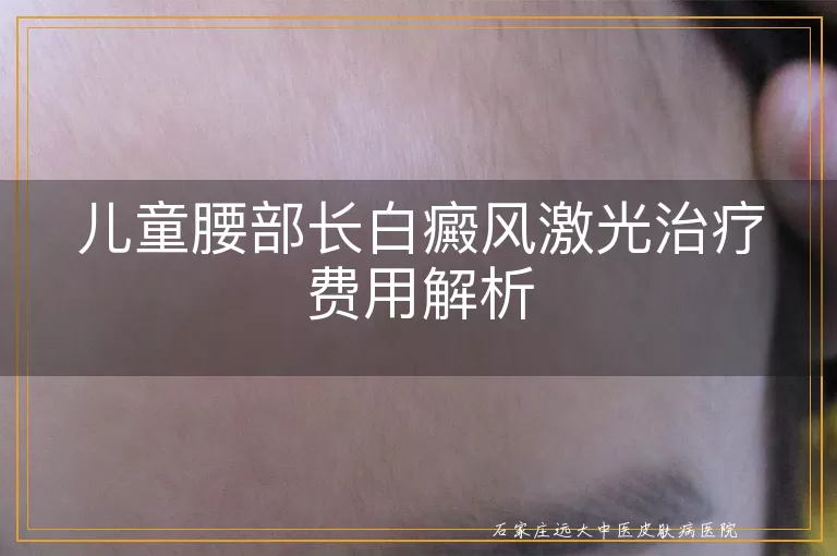 儿童腰部长白癜风激光治疗费用解析