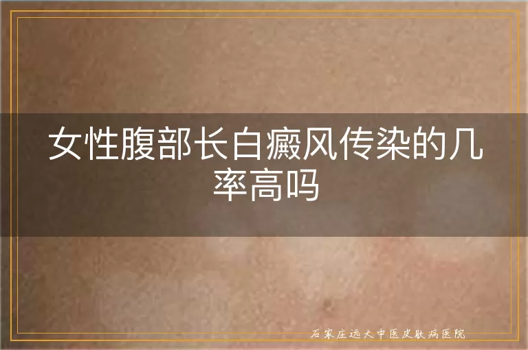女性腹部长白癜风传染的几率高吗