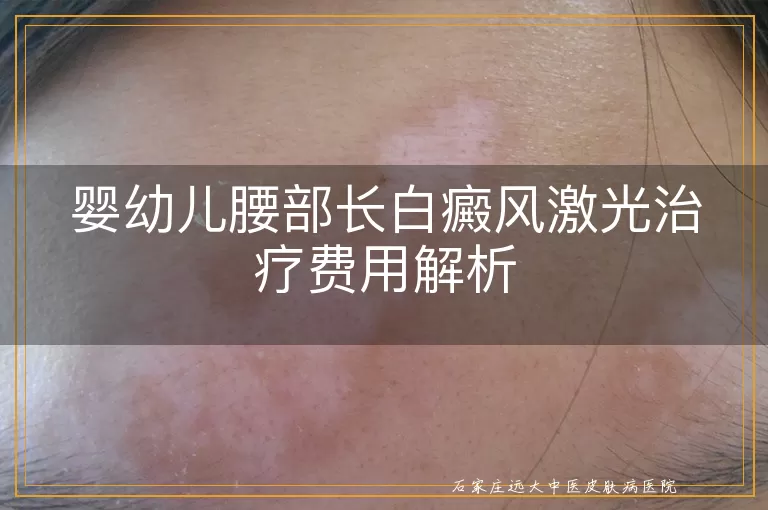 婴幼儿腰部长白癜风激光治疗费用解析