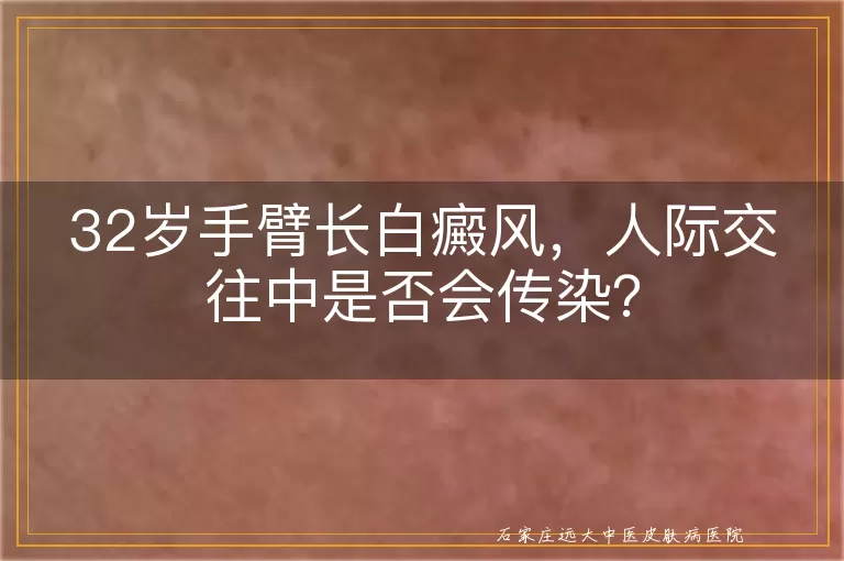 32岁手臂长白癜风，人际交往中是否会传染？