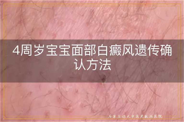 4周岁宝宝面部白癜风遗传确认方法