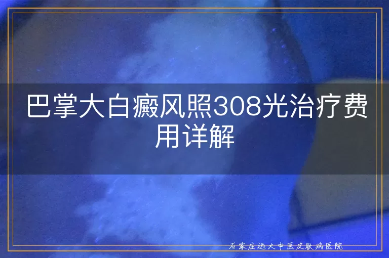 巴掌大白癜风照308光治疗费用详解