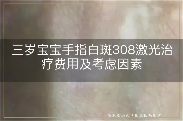 三岁宝宝手指白斑308激光治疗费用及考虑因素