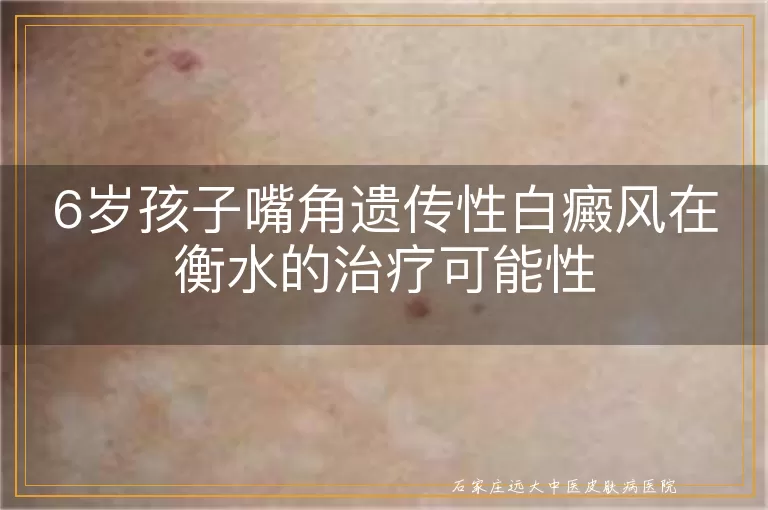 6岁孩子嘴角遗传性白癜风在衡水的治疗可能性