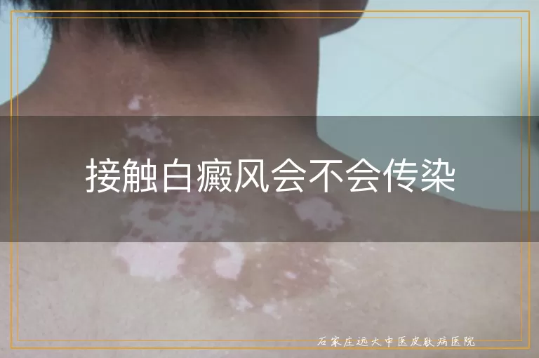 接触白癜风会不会传染