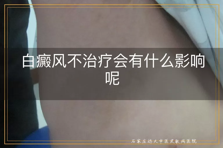 白癜风不治疗会有什么影响呢