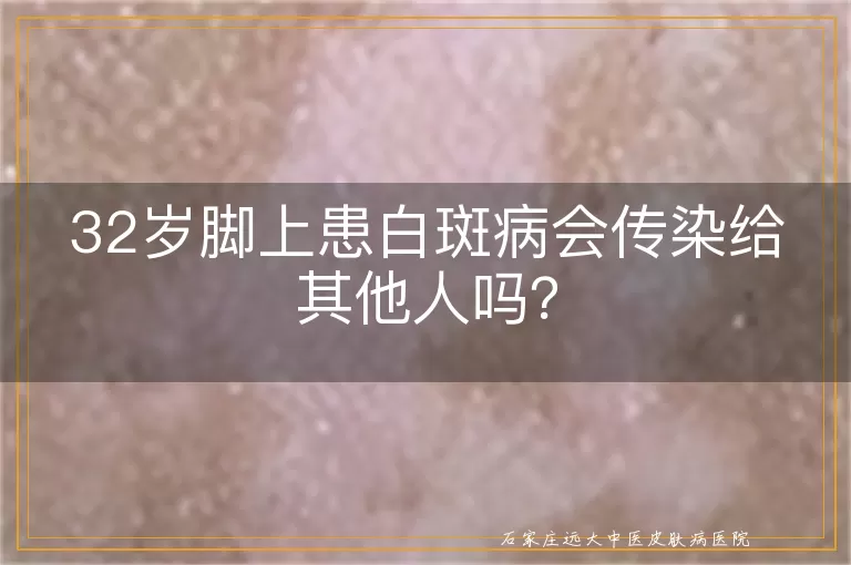 32岁脚上患白斑病会传染给其他人吗？