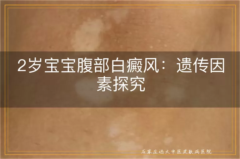 2岁宝宝腹部白癜风：遗传因素探究