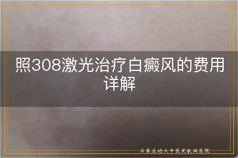 照308激光治疗白癜风的费用详解