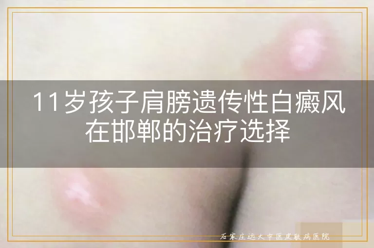11岁孩子肩膀遗传性白癜风在邯郸的治疗选择