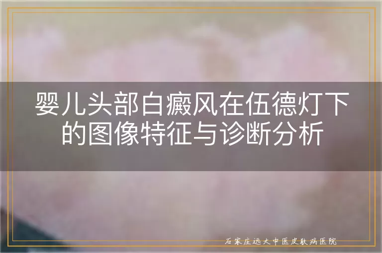 婴儿头部白癜风在伍德灯下的图像特征与诊断分析