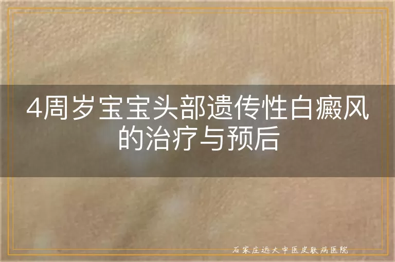 4周岁宝宝头部遗传性白癜风的治疗与预后