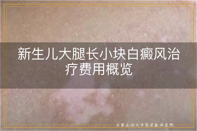 新生儿大腿长小块白癜风治疗费用概览