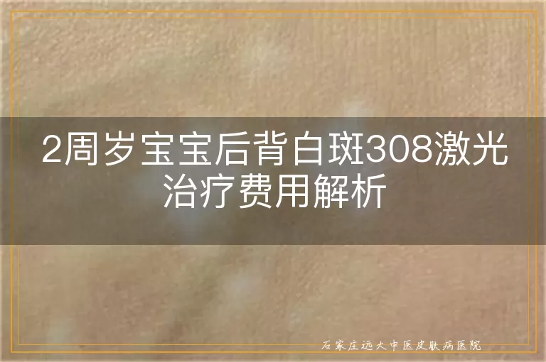 2周岁宝宝后背白斑308激光治疗费用解析