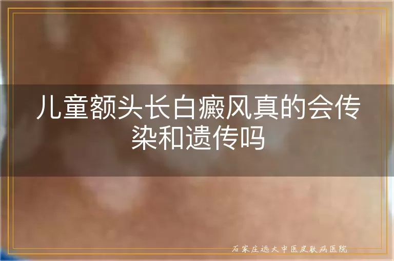 儿童额头长白癜风真的会传染和遗传吗