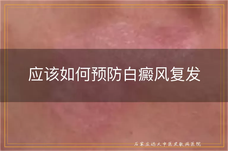 应该如何预防白癜风复发
