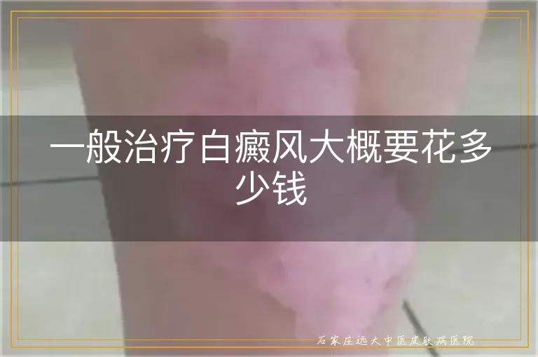 一般治疗白癜风大概要花多少钱