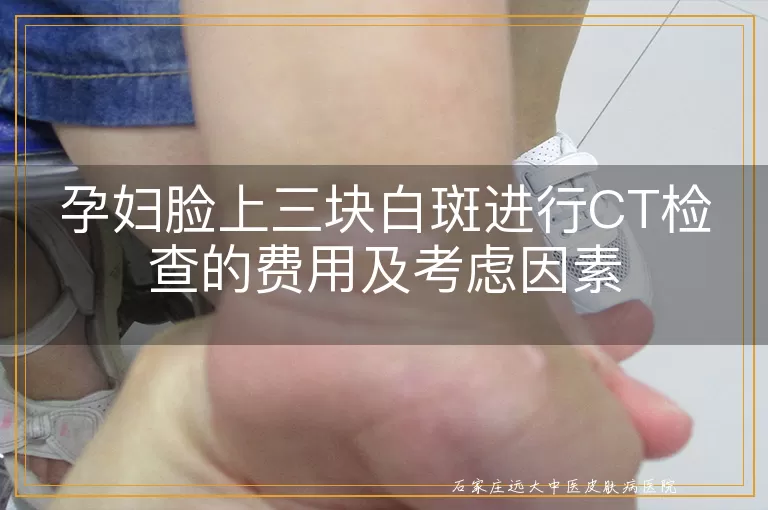 孕妇脸上三块白斑进行CT检查的费用及考虑因素