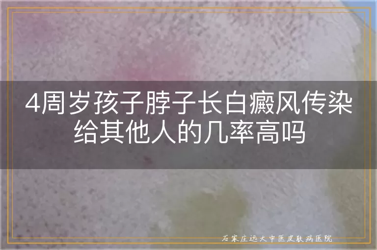 4周岁孩子脖子长白癜风传染给其他人的几率高吗
