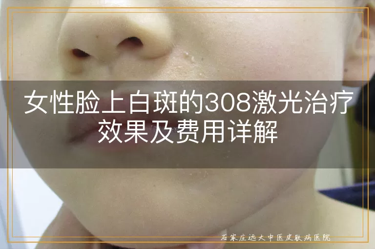 女性脸上白斑的308激光治疗效果及费用详解