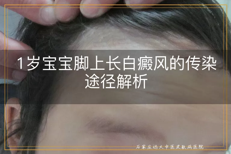 1岁宝宝脚上长白癜风的传染途径解析