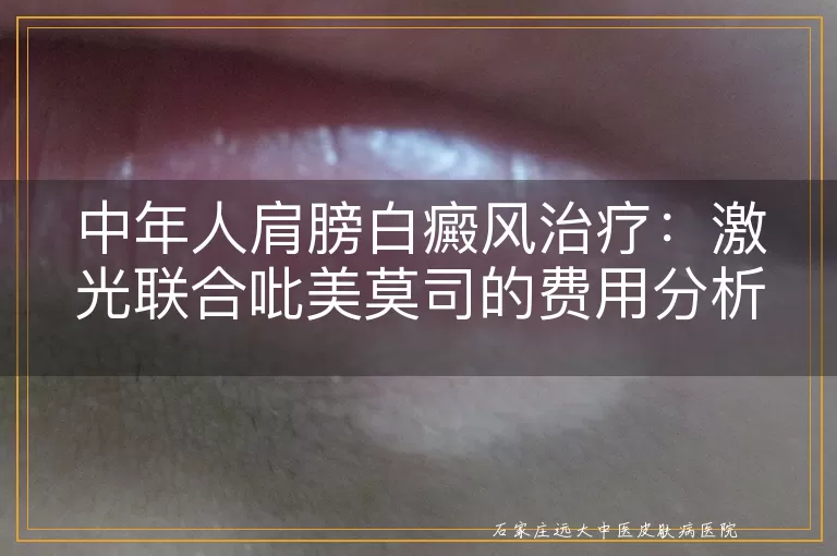 中年人肩膀白癜风治疗：激光联合吡美莫司的费用分析