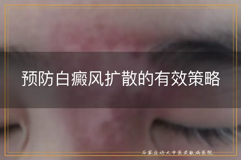 预防白癜风扩散的有效策略