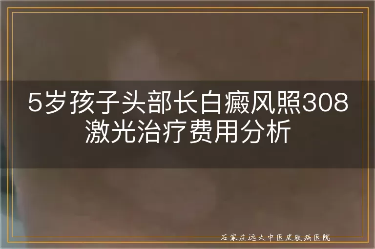 5岁孩子头部长白癜风照308激光治疗费用分析
