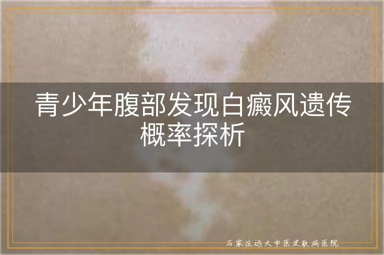 青少年腹部发现白癜风遗传概率探析