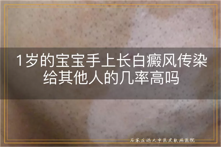 1岁的宝宝手上长白癜风传染给其他人的几率高吗