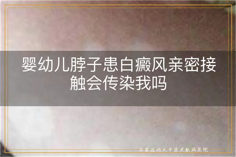 婴幼儿脖子患白癜风亲密接触会传染我吗