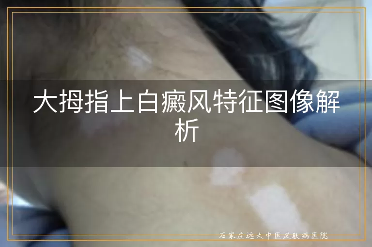大拇指上白癜风特征图像解析