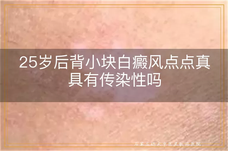 25岁后背小块白癜风点点真具有传染性吗
