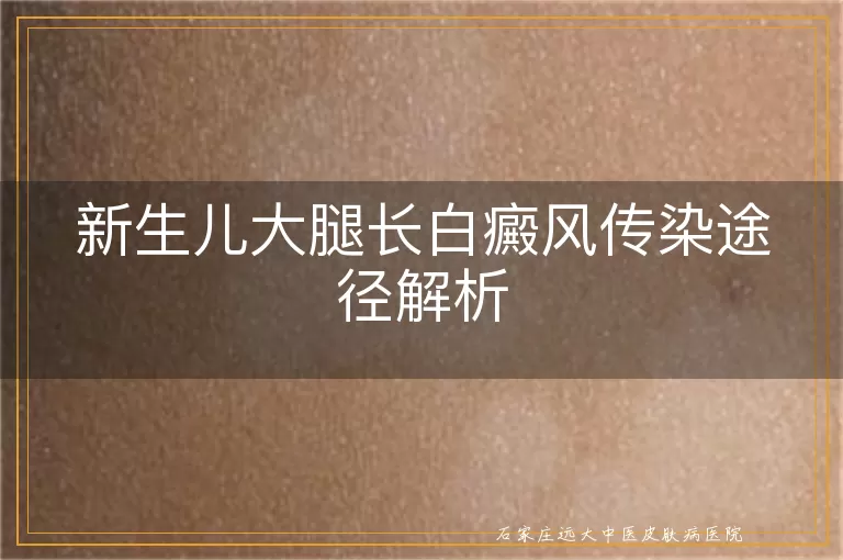 新生儿大腿长白癜风传染途径解析